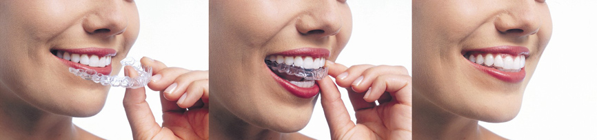 Invisalign aligners aligneurs coquilles transparentes orthodontistes Lemay