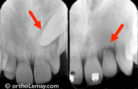 Resorption racine root resorption orthodontics ? OrthoLemay.com Résorption imortante d'une dent latérale causée par une canine incluse.