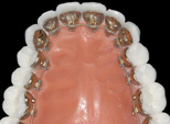 broches linguales invisibles ibraces Orthodontistes lemay Broches iBraces posées sur la face linguale des dents
