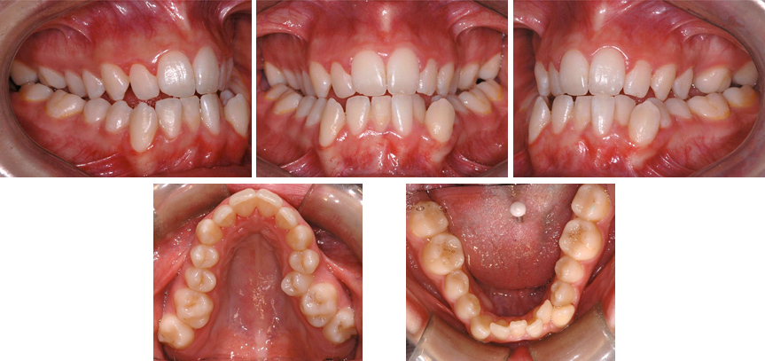 Bilateral posterior crossbite occlusion croisée postérieure bilatérale Orthodontistes Lemay 093014BC Occlusion croisée postérieure bilatérale; contraction importante de la mâchoire supérieure