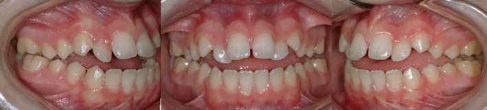 Béance antérieure et postérieure affectant la mastication et la phonétique