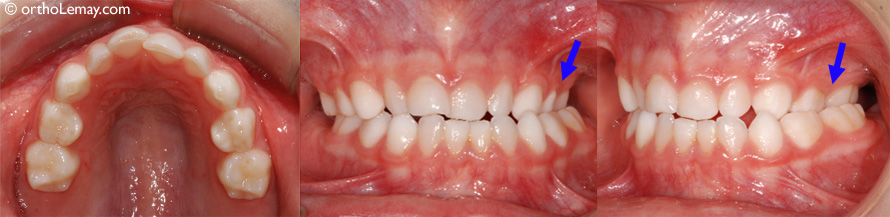 Occlusion croisée postérieure corssbite 5 ans © orthoLemay.com Occlusion croisée postérieure en dentition temporaire (garçon de 5 ans). Cette condition persistera en dentition permanente