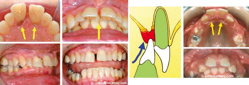 En présence d'un surplomb antérieur vertical excessif (overbite), les dents inférieures peuvent mordre dans la muqueuse du palais et l'endommager en causant du déchaussement et éventuellement une perte osseues.