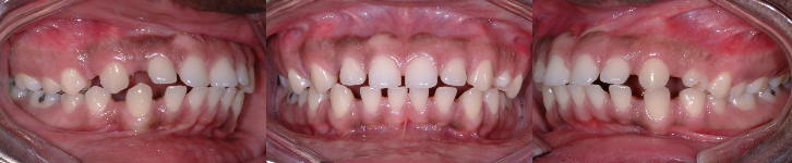 Espaces inter-dentaires Espaces excessifs entre les dents