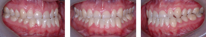 Occlusion croisée antérieure postérieure crossbite 1 Occlusion croisée antérieure et déviation de la mâchoire inférieure vers la gauche