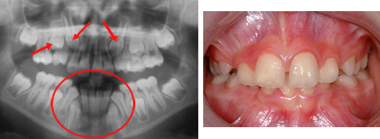 Problèmes d'ruption radiographie panoramique © orthoLemay.com Perte d'espace et problèmes d'éruption visibles sur une rsdiographie d'un jeune garçon de 11 ans