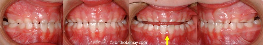 Usure excessive affectant les dents temporaires chez une fille de 6 ans. Les dents permanentes nouvellement sorties ne sont pas affectées (flèche).