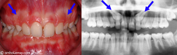 Canines ectopiques incluses radiographie impacted cuspids 535071 Une radiographie permet de déceler chez cette fille de 12 ans un problème d'éruption sérieux; les deux canines supérieures sont incluses et se dirigent vers les palais. L'examen de la dentition sans radiographie rend ce diagnostic difficile à établir.