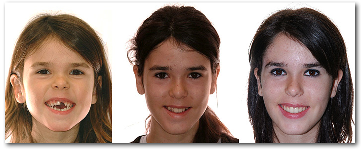 Sourire  orthodontie AD 023263 S orthoLemay.com Sherbrooke