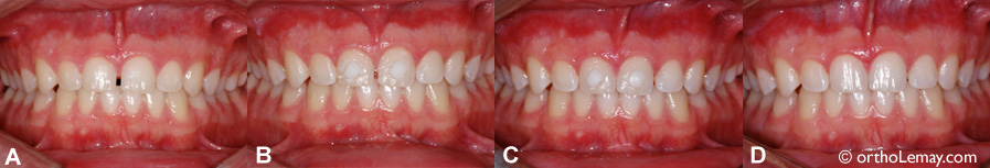 Fermeture D'espace Et Diastèmes | Bücco
